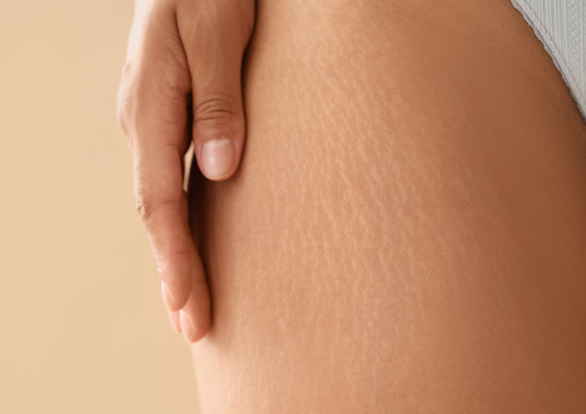 Jak zredukować rozstępy po ciąży? Sprawdź, co na rozstępy po ciąży działa skutecznie i naturalnie
